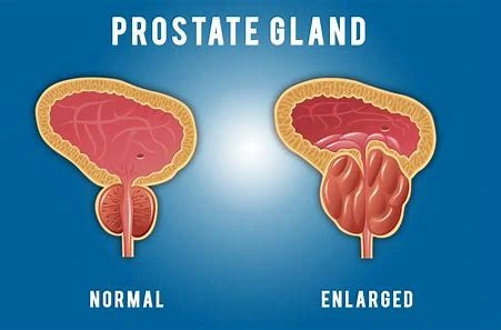 Prostate